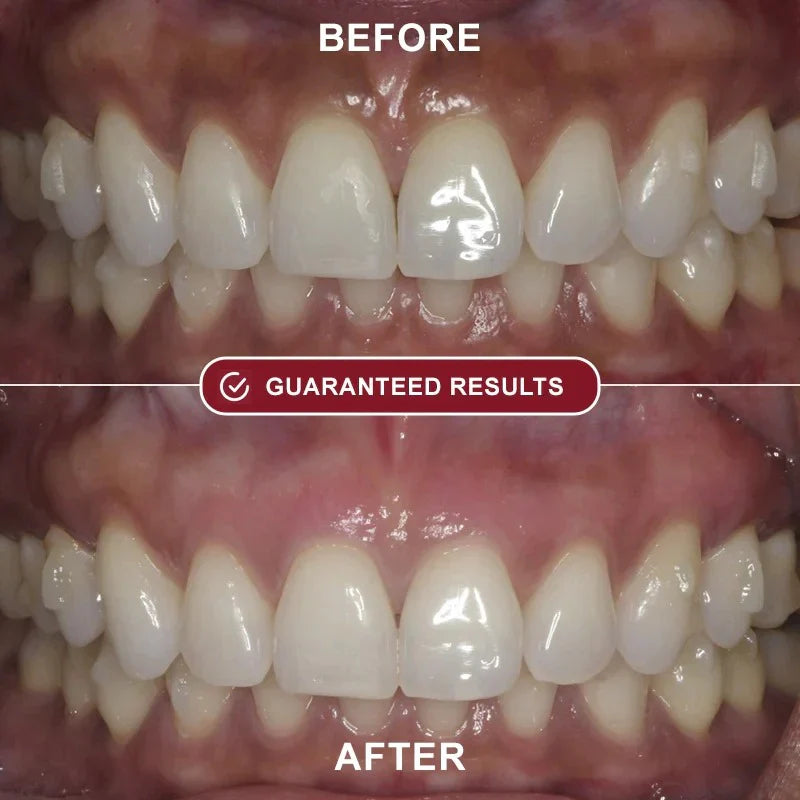 PureBright™ - Teeth Whitening Kit