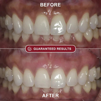 PureBright™ - Teeth Whitening Kit